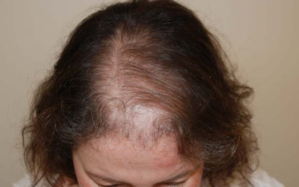 Traitement pour la perte des cheveux chez les femmes - Alopécie féminine